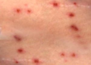Krätzmilben- Milbenbisse Haut