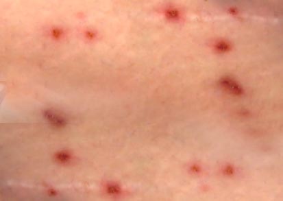 Krätze-Anfangsstadium-foto-bild Krätze-Anfangsstadium-foto-bild